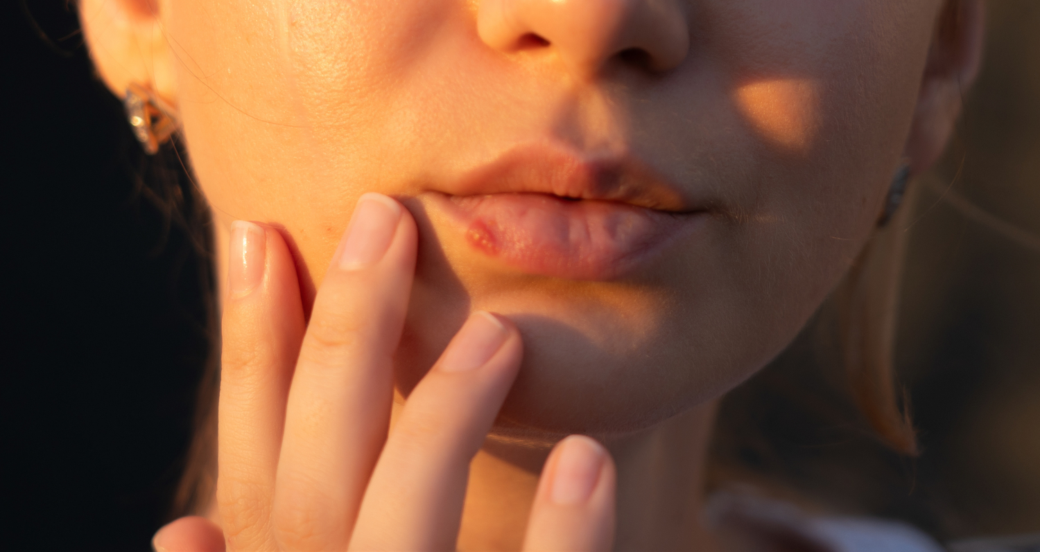 Cold Sores: Natural Support with Essential Oils