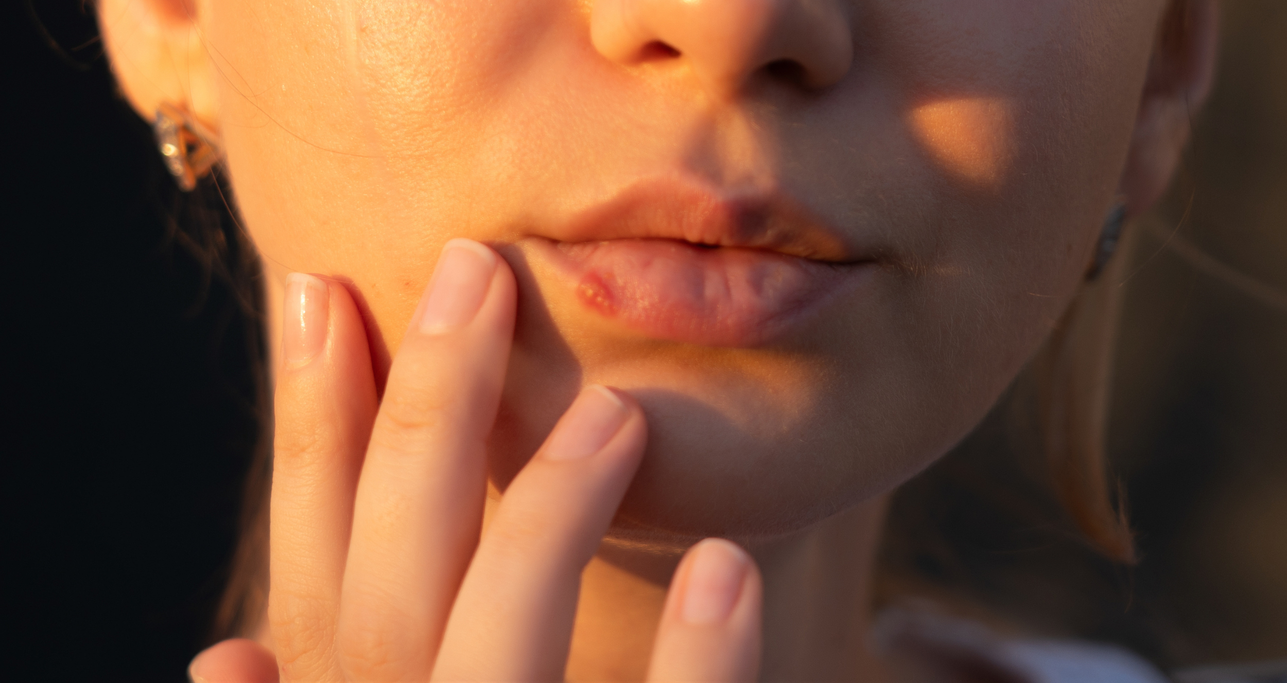 Cold Sores: Natural Support with Essential Oils