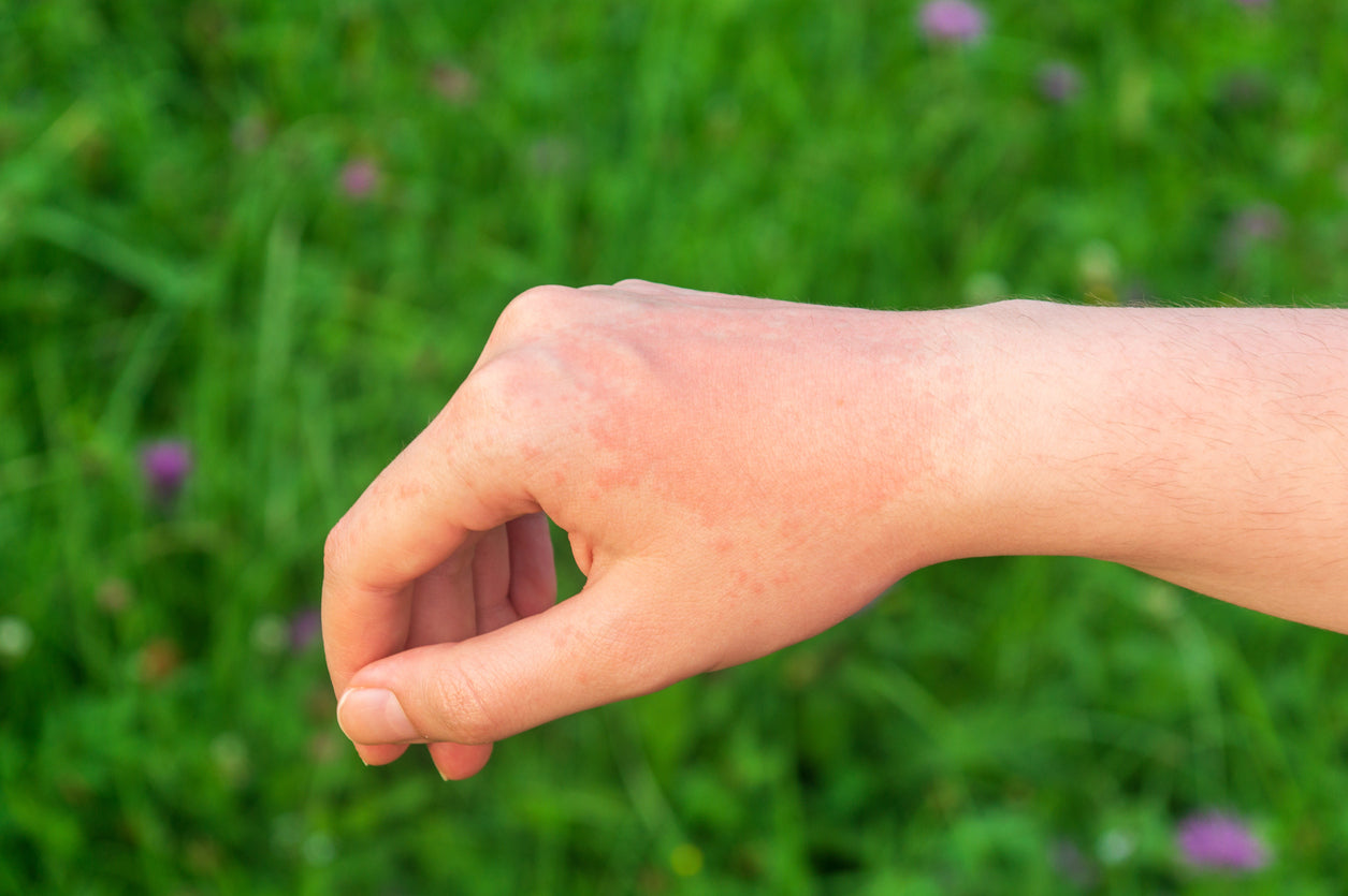 Sun Allergy: Symptoms & Soothers.